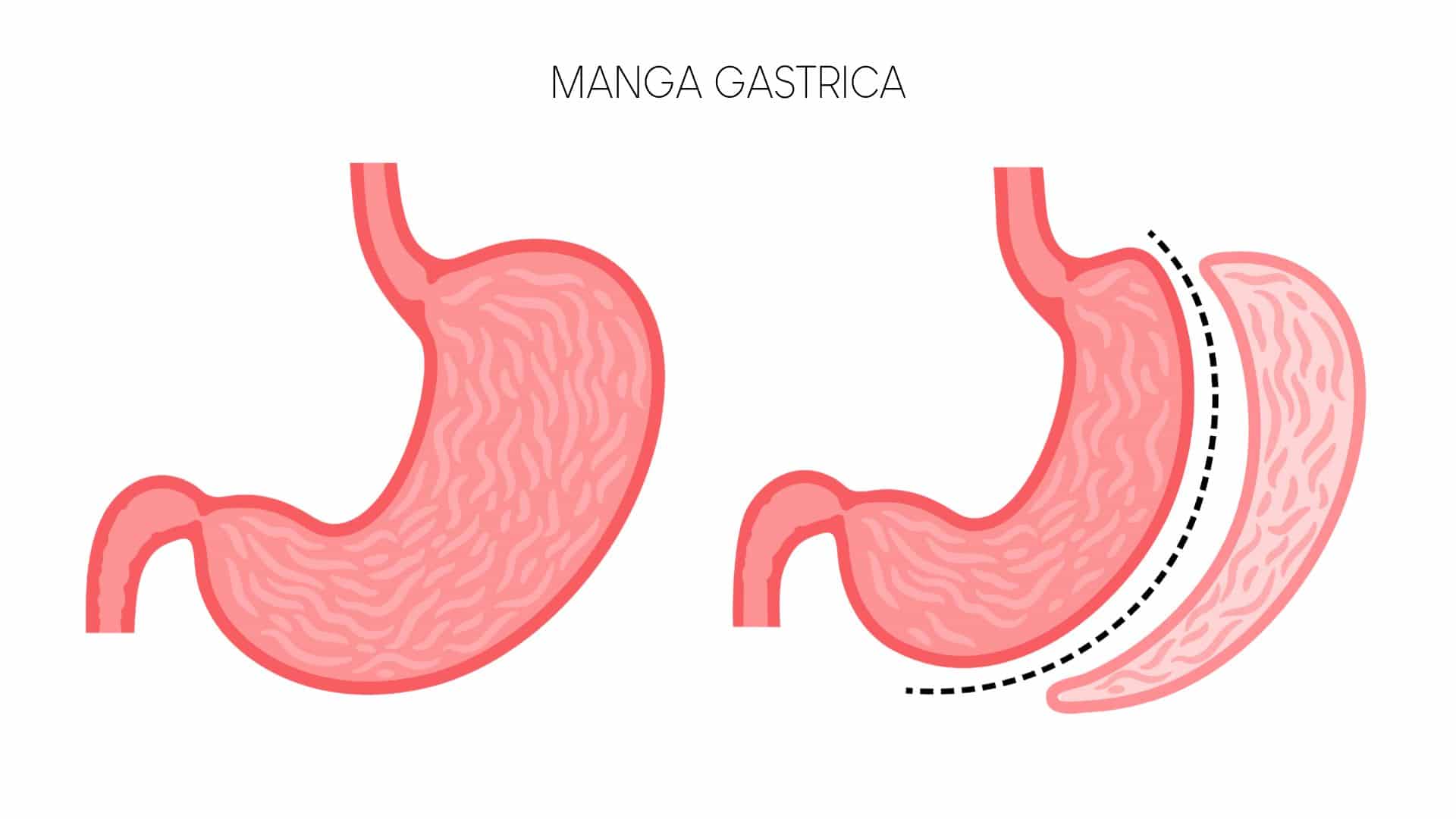 Procedimiento de manga gástrica en Uruguay.