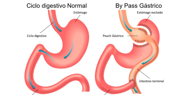 procedimiento de bypass gástrico en Uruguay.